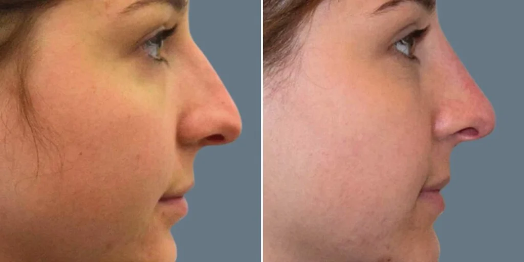 face non surgical nose reshape female pre2024 005 before and after before and after