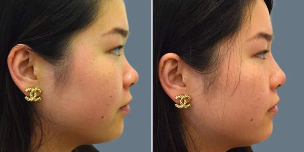 face non surgical nose reshape female pre2024 007 before and after before and after