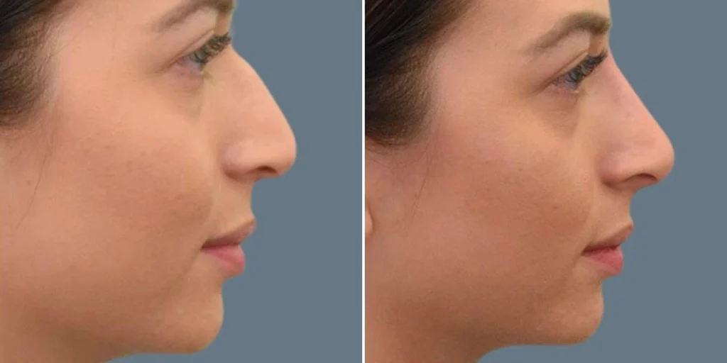 face non surgical nose reshape female pre2024 008 before and after before and after