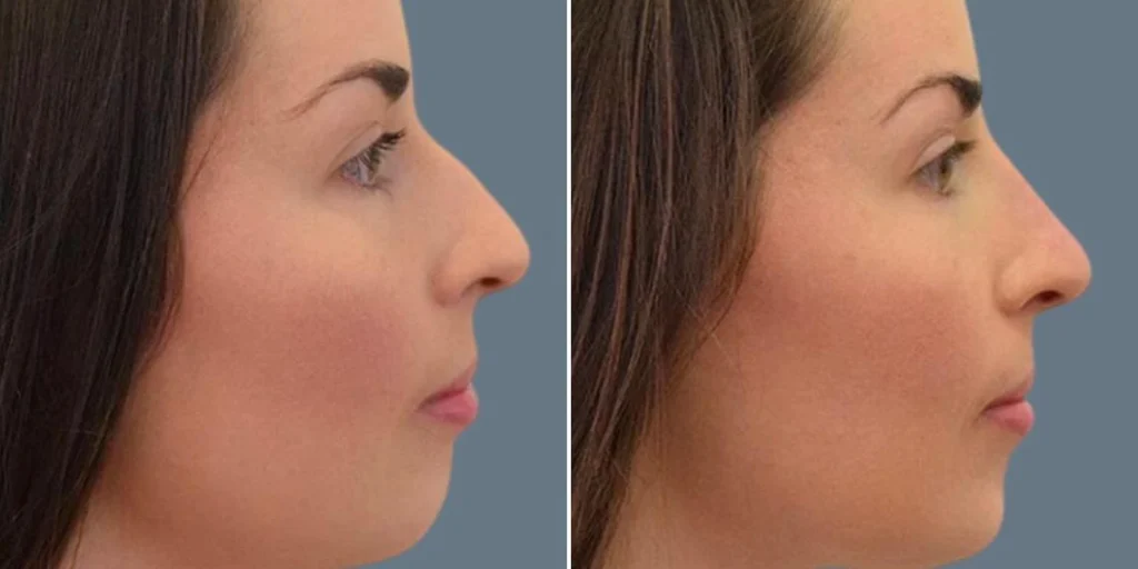 face non surgical nose reshape female pre2024 009 before and after before and after