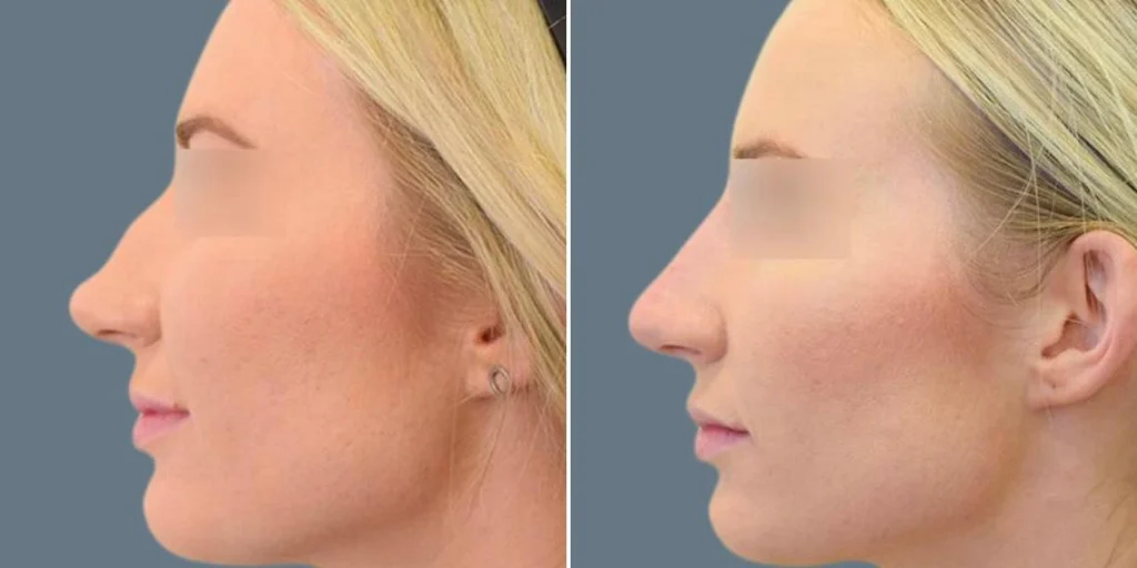 face non surgical nose reshape female pre2024 010 before and after before and after