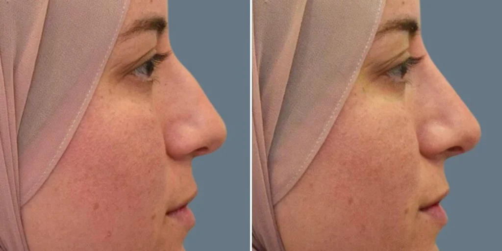 face non surgical nose reshape female pre2024 011 before and after before and after