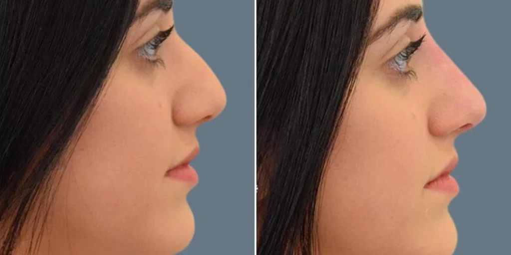 face non surgical nose reshape female pre2024 012 before and after before and after