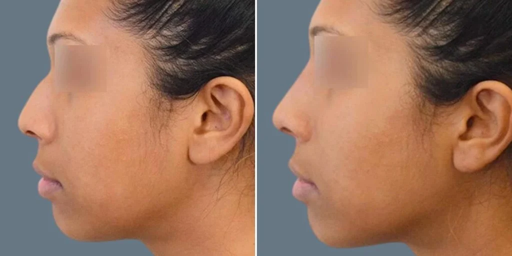 face non surgical nose reshape female pre2024 013 before and after before and after