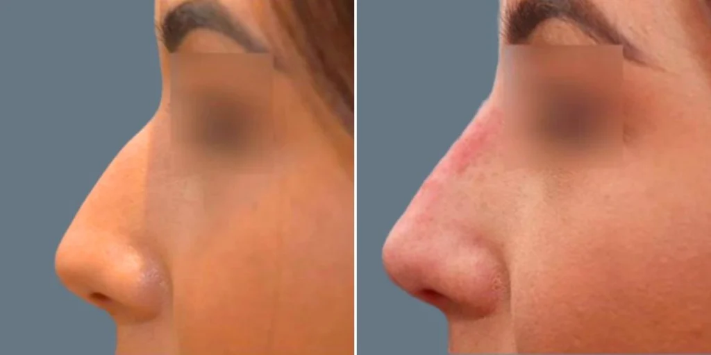 face non surgical nose reshape female pre2024 014 before and after before and after