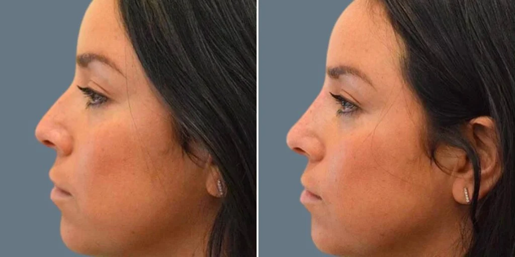 face non surgical nose reshape female pre2024 015 before and after before and after