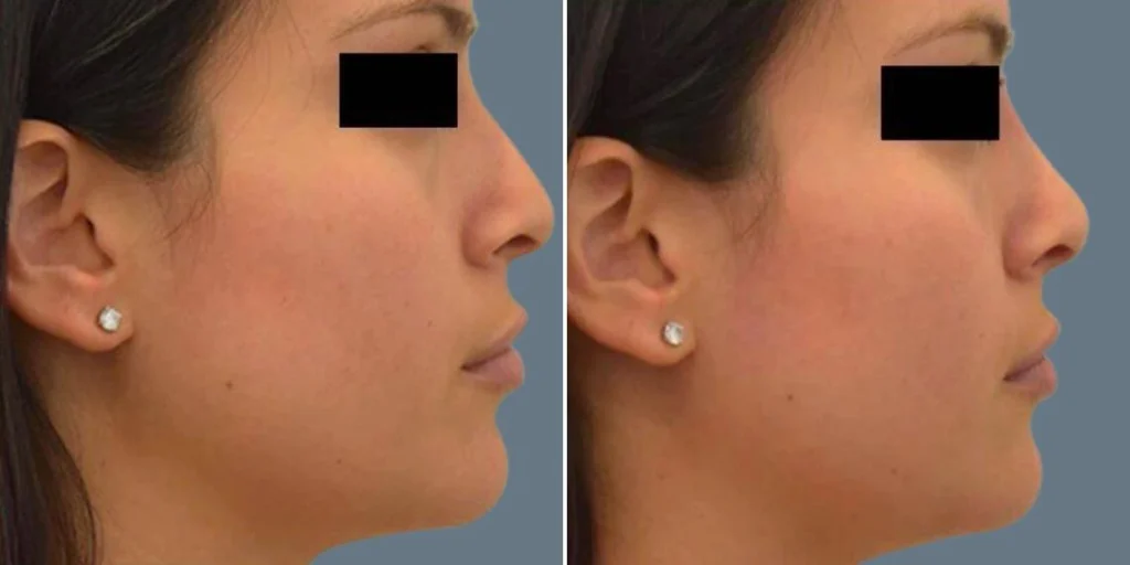 face non surgical nose reshape female pre2024 016 before and after before and after