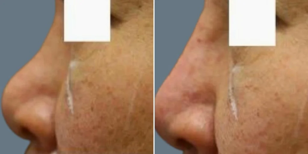 face non surgical nose reshape female pre2024 019 before and after before and after