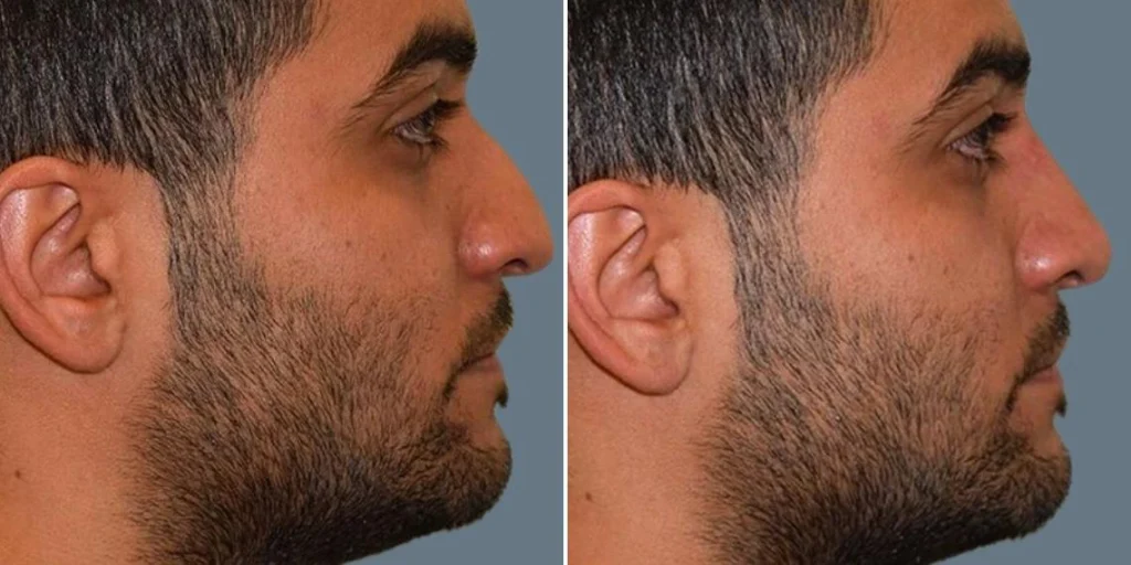 face non surgical nose reshape male pre2024 002 before and after before and after