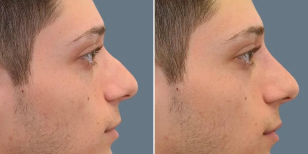 face non surgical nose reshape male pre2024 004 before and after before and after