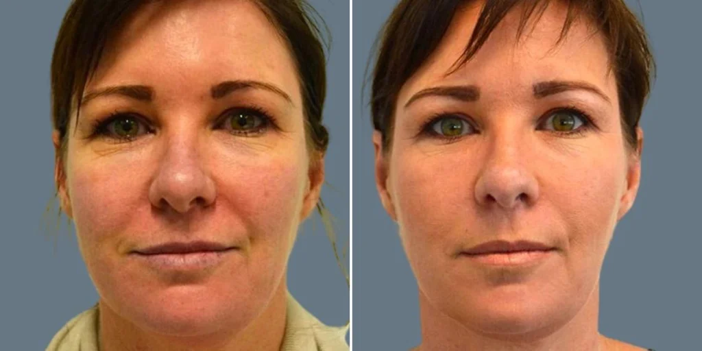 face silhouette soft face lift female pre2024 003 before and after before and after
