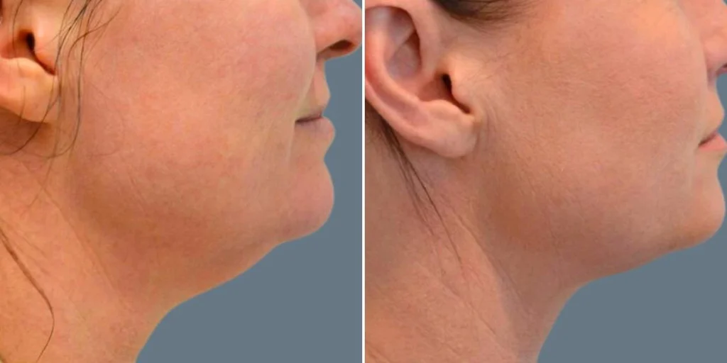 face silhouette soft face lift female pre2024 004 before and after before and after