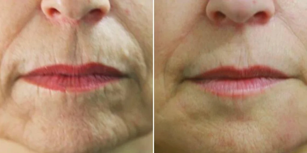 face smokers wrinkles lift female pre2024 001 before and after before and after