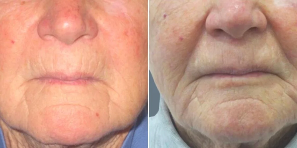 face smokers wrinkles lift female pre2024 002 before and after before and after