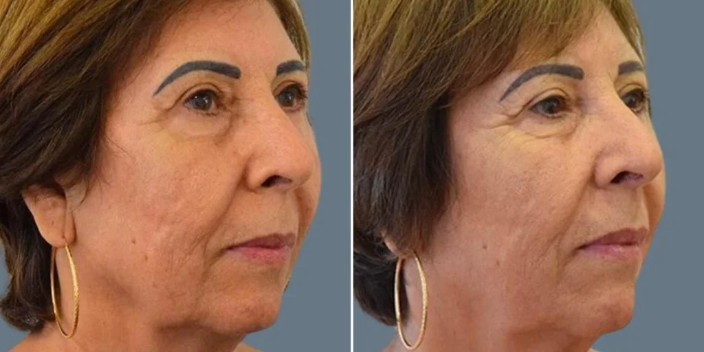 face ultraformer female pre2024 002 before and after before and after