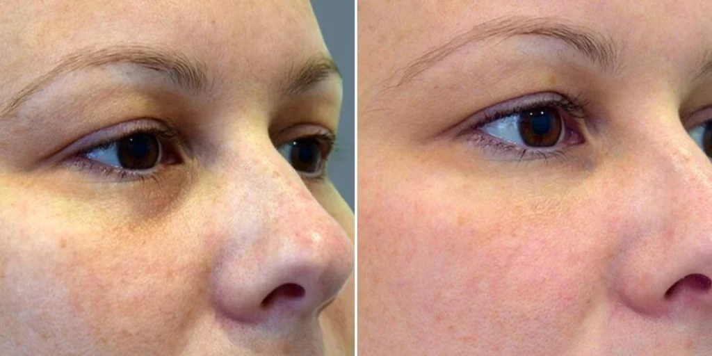 face under eyes female pre2024 001 before and after before and after