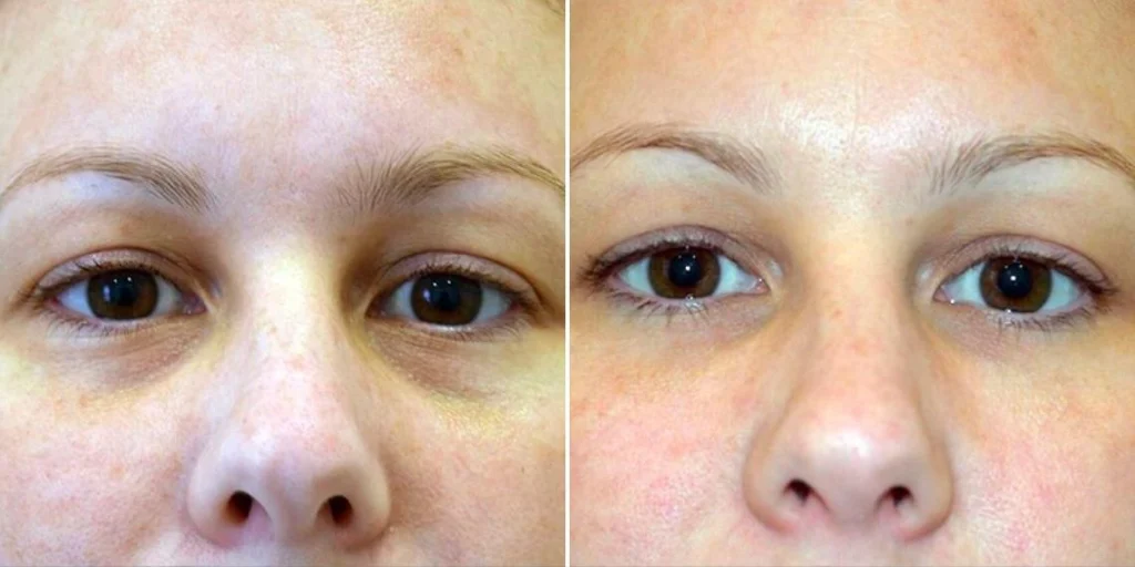 face under eyes female pre2024 004 before and after before and after