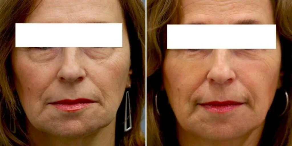 face under eyes female pre2024 006 before and after before and after