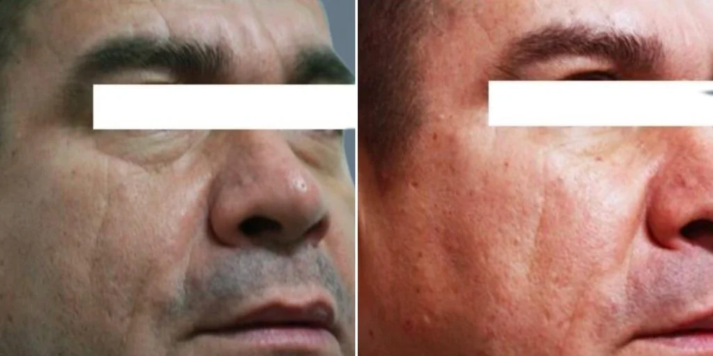 face under eyes male pre2024 007 before and after before and after