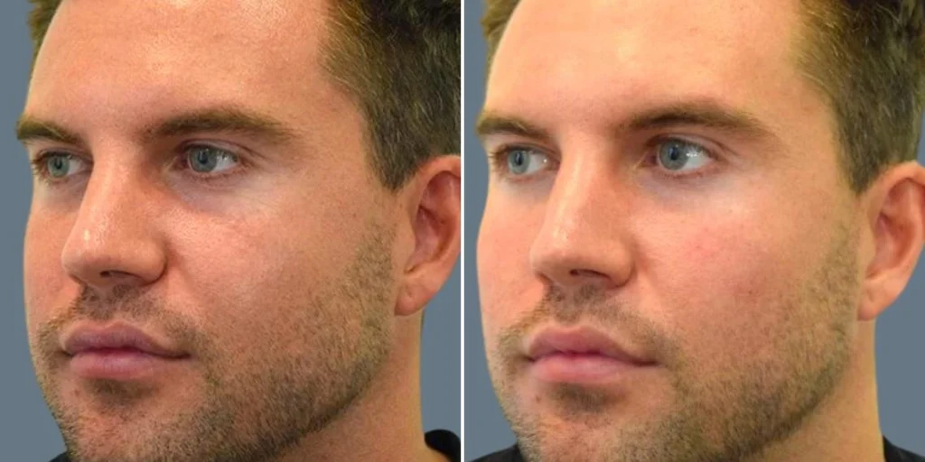 face under eyes male pre2024 008 before and after before and after