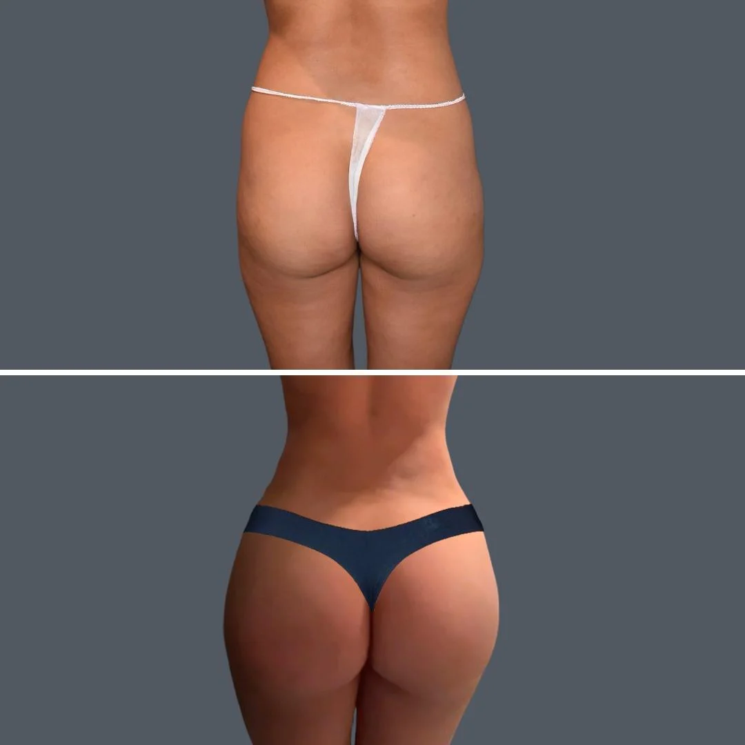 Fat Transfer to Buttocks (BBL) Before & After before and after at Cosmos Clinic