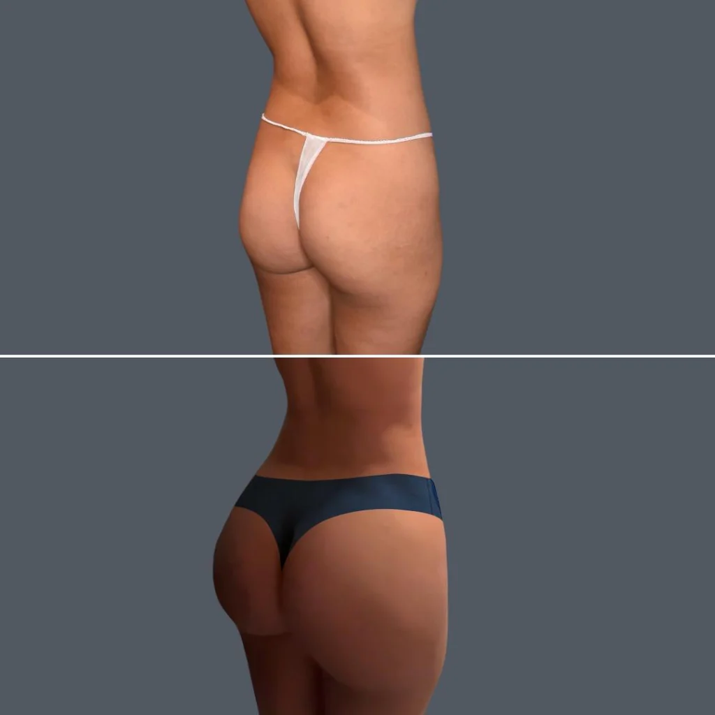 gold coast bbl liposuction female 2024 002 before and after before and after