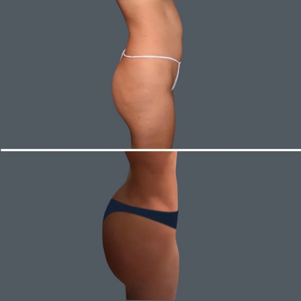 gold coast stomach liposuction female 2024 001 before and after before and after