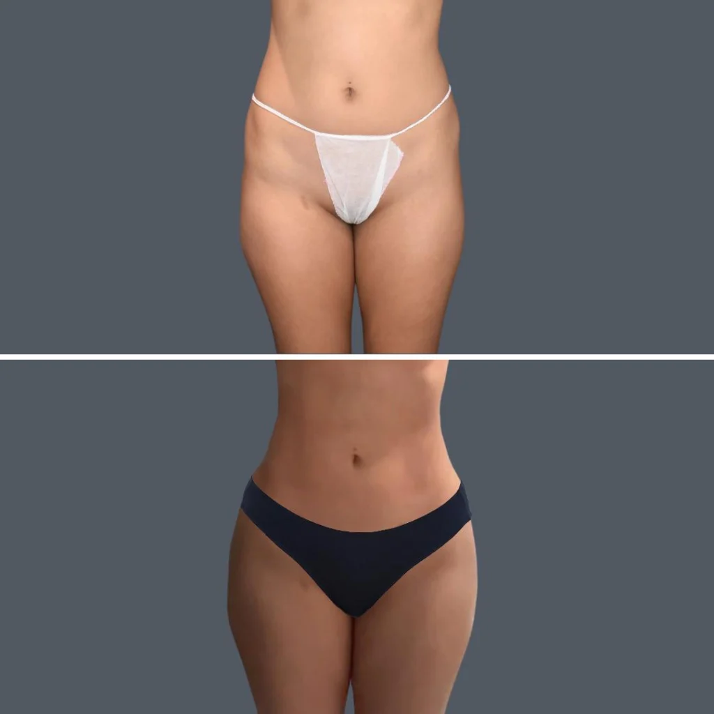 gold coast stomach liposuction female 2024 003 before and after before and after