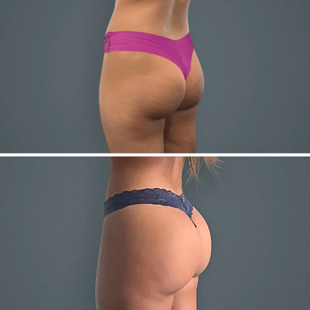 goldcoast bbl butt female 2023 left 108 before and after before and after