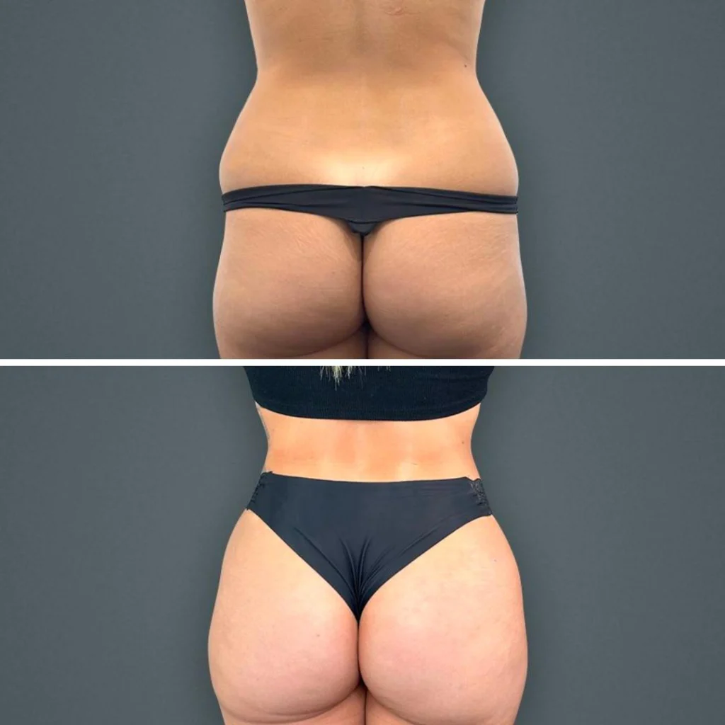 goldcoast bbl butt female 2023 rear 111 before and after before and after