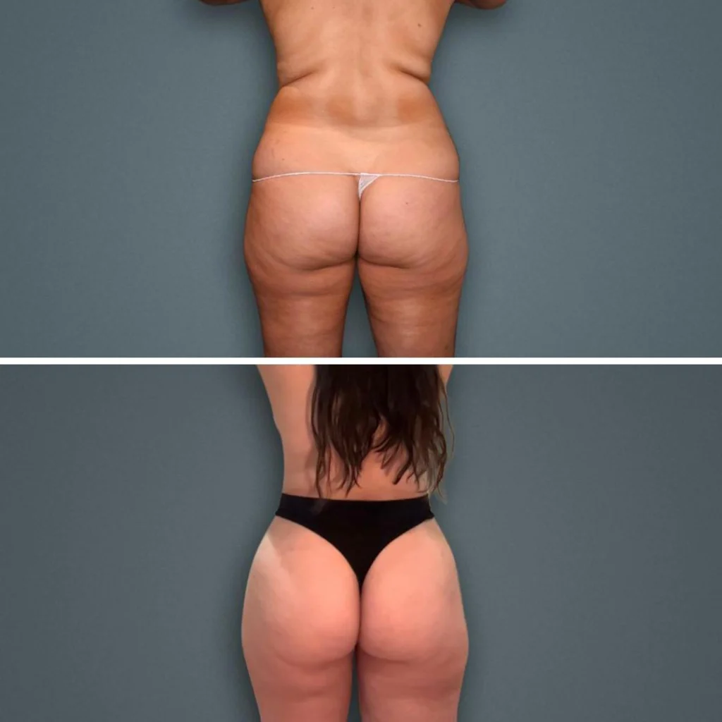 goldcoast bbl butt female 2023 rear 115 before and after before and after