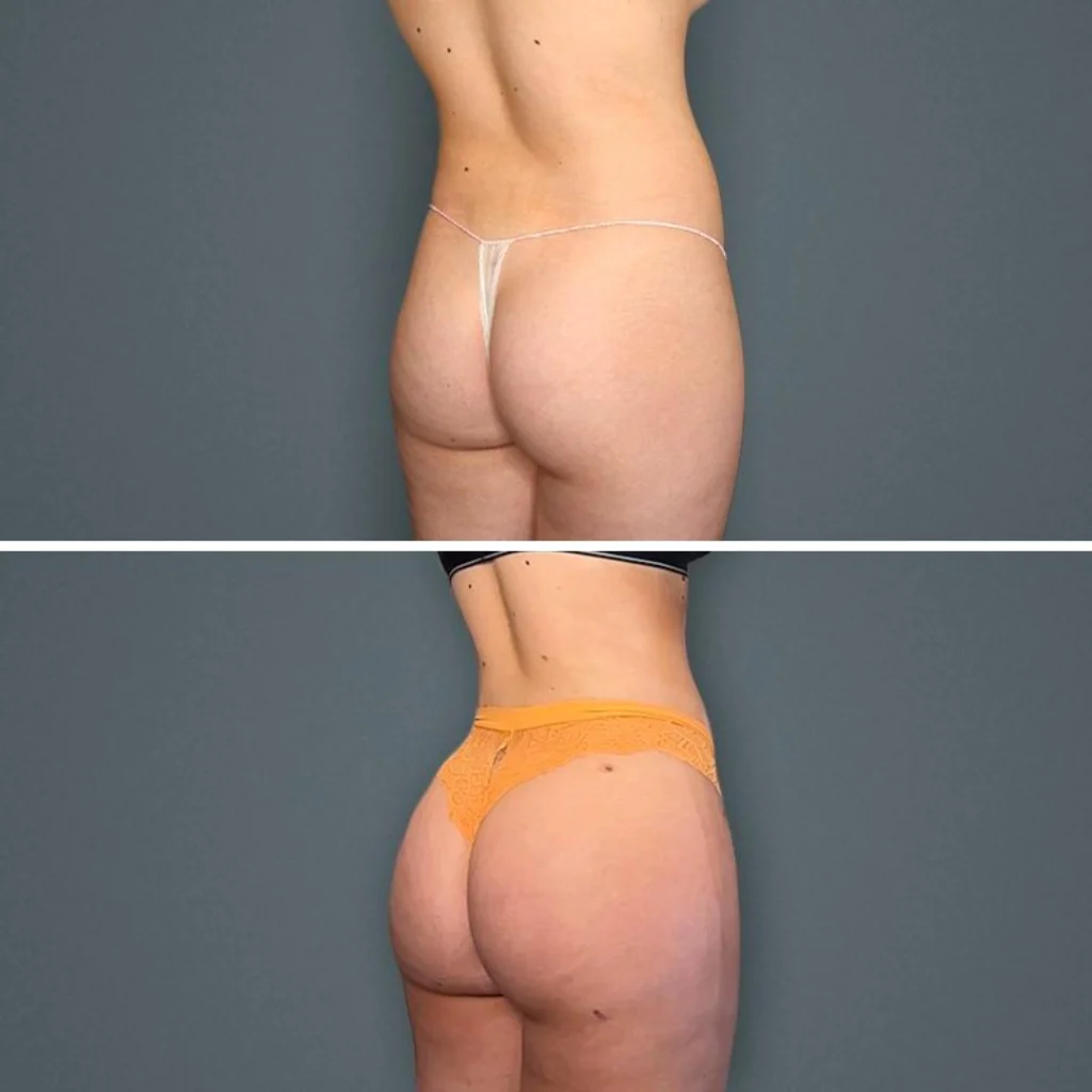 goldcoast bbl butt female 2023 right 122 before and after before and after