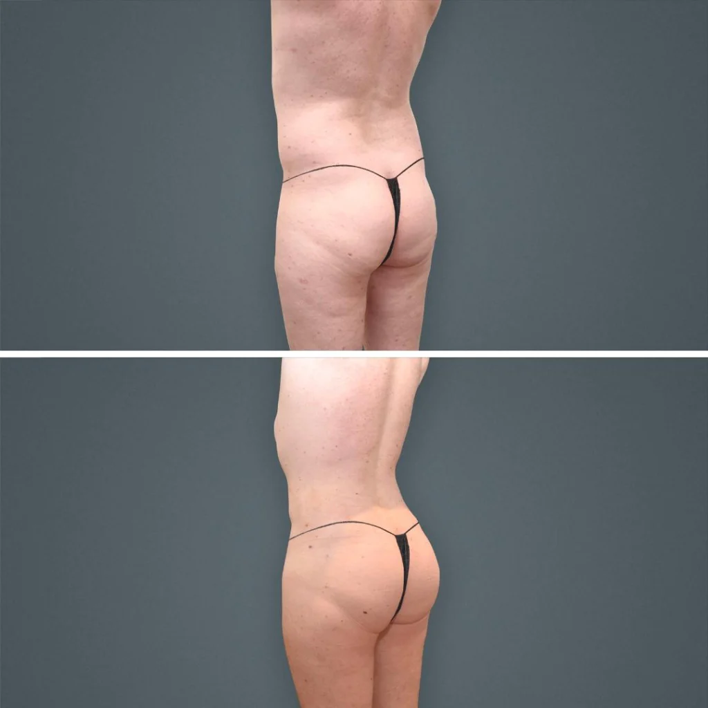 goldcoast bbl butt male 2023 left 210 before and after before and after