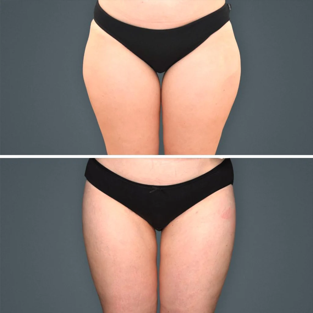 goldcoast coolsculpting legs female 2023 front 182 before and after before and after