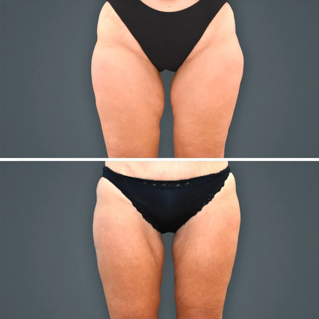 goldcoast coolsculpting legs female 2023 front 203 before and after before and after