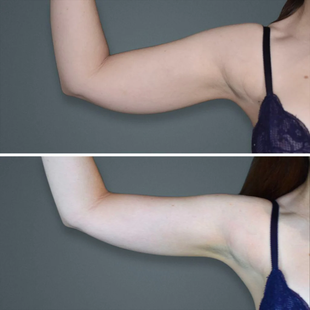 goldcoast liposuction arm female 2023 right 101 before and after before and after