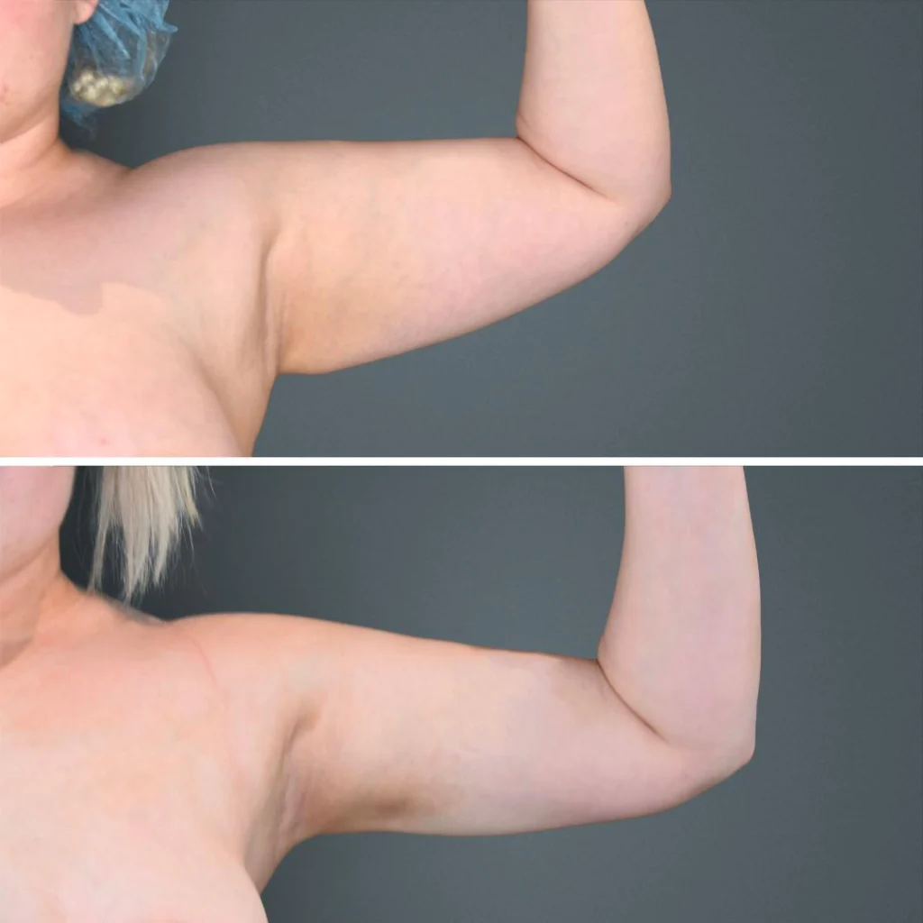 goldcoast liposuction arm female 2023 right 214 before and after before and after