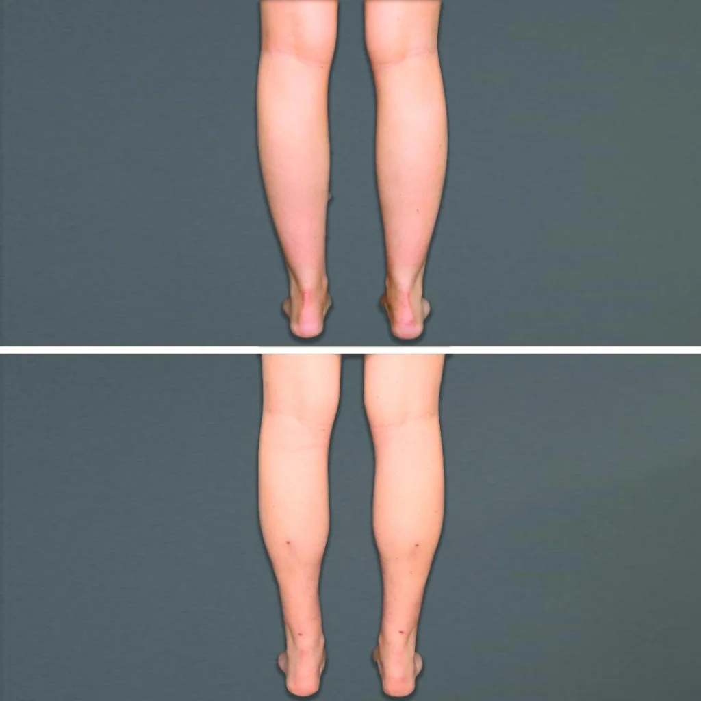 goldcoast liposuction calf female 2022 rear 68 before and after before and after
