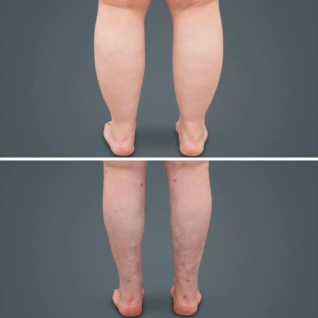 goldcoast liposuction calf female 2023 rear 144 before and after before and after