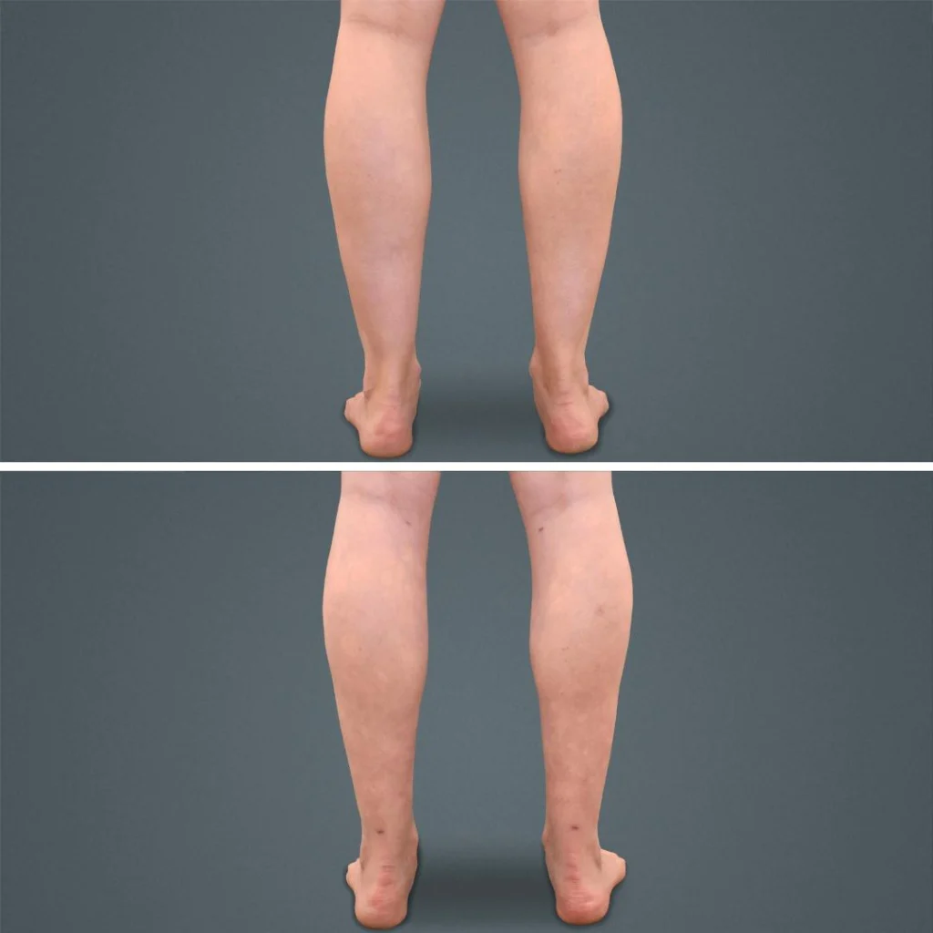 goldcoast liposuction calf female 2023 rear 156 before and after before and after