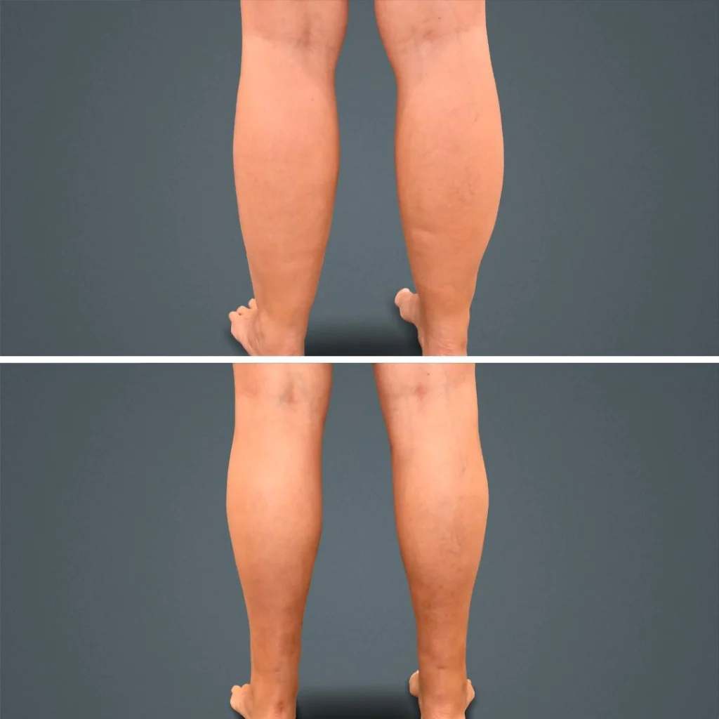 goldcoast liposuction calf female 2023 rear 161 before and after before and after