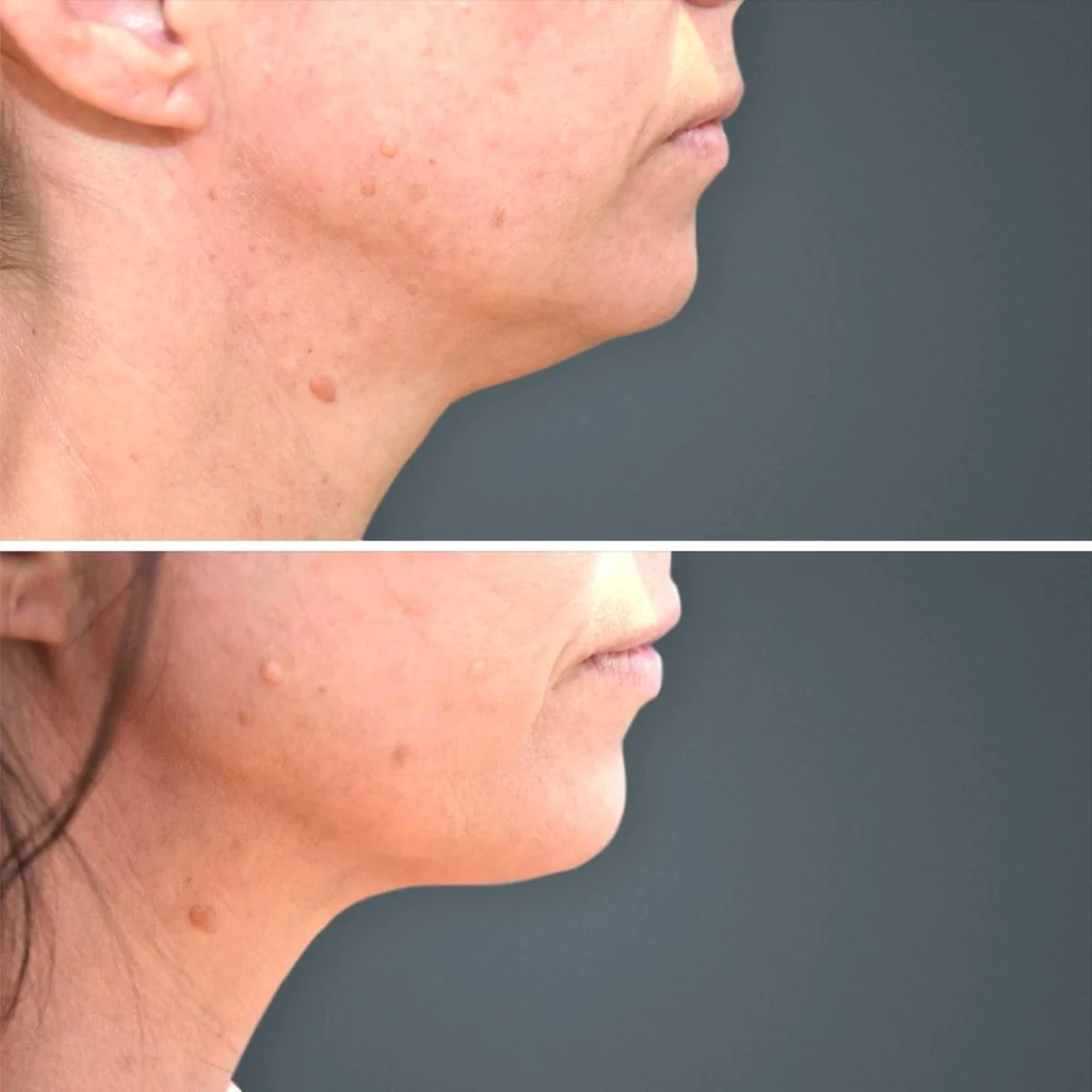 Before and after liposuction of the face.