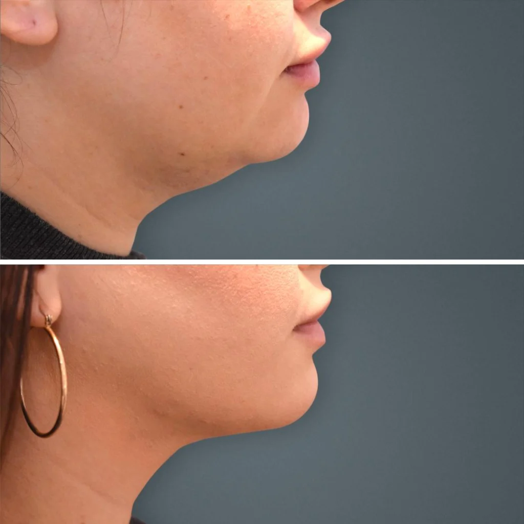 goldcoast liposuction face female 2023 left 194 before and after before and after