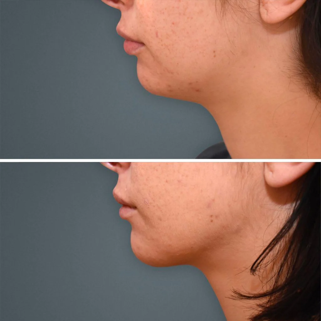 goldcoast liposuction face female 2023 right 198 before and after before and after