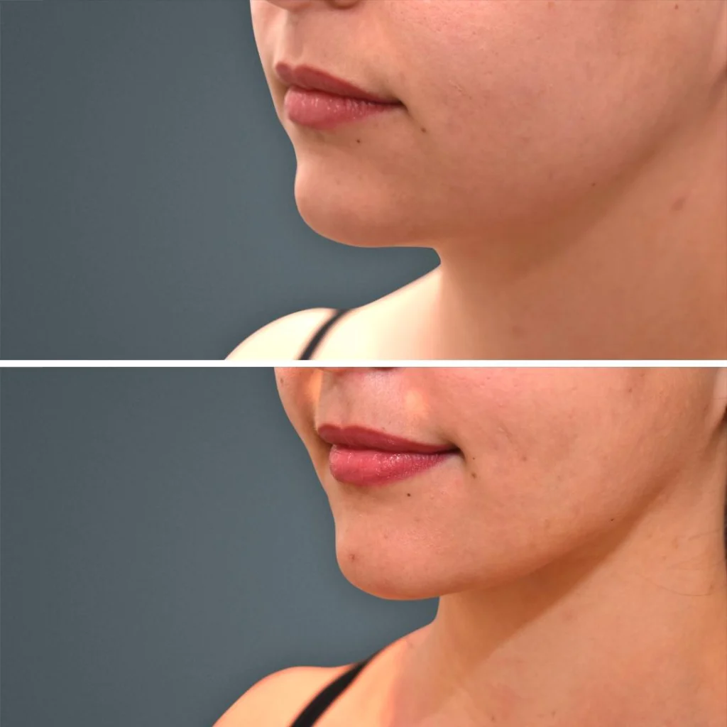 goldcoast liposuction face female 2023 right 199 before and after before and after