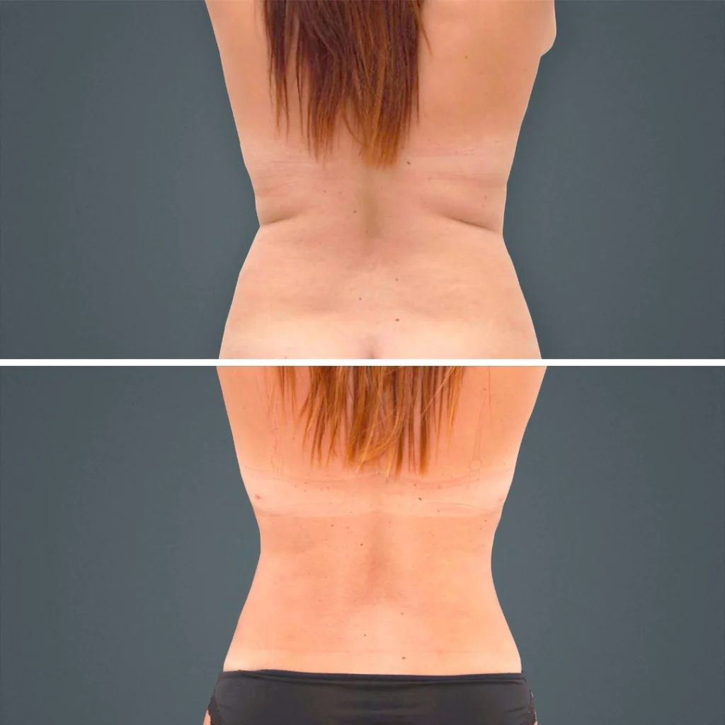 goldcoast liposuction lovehandles female 2023 rear 136 before and after before and after
