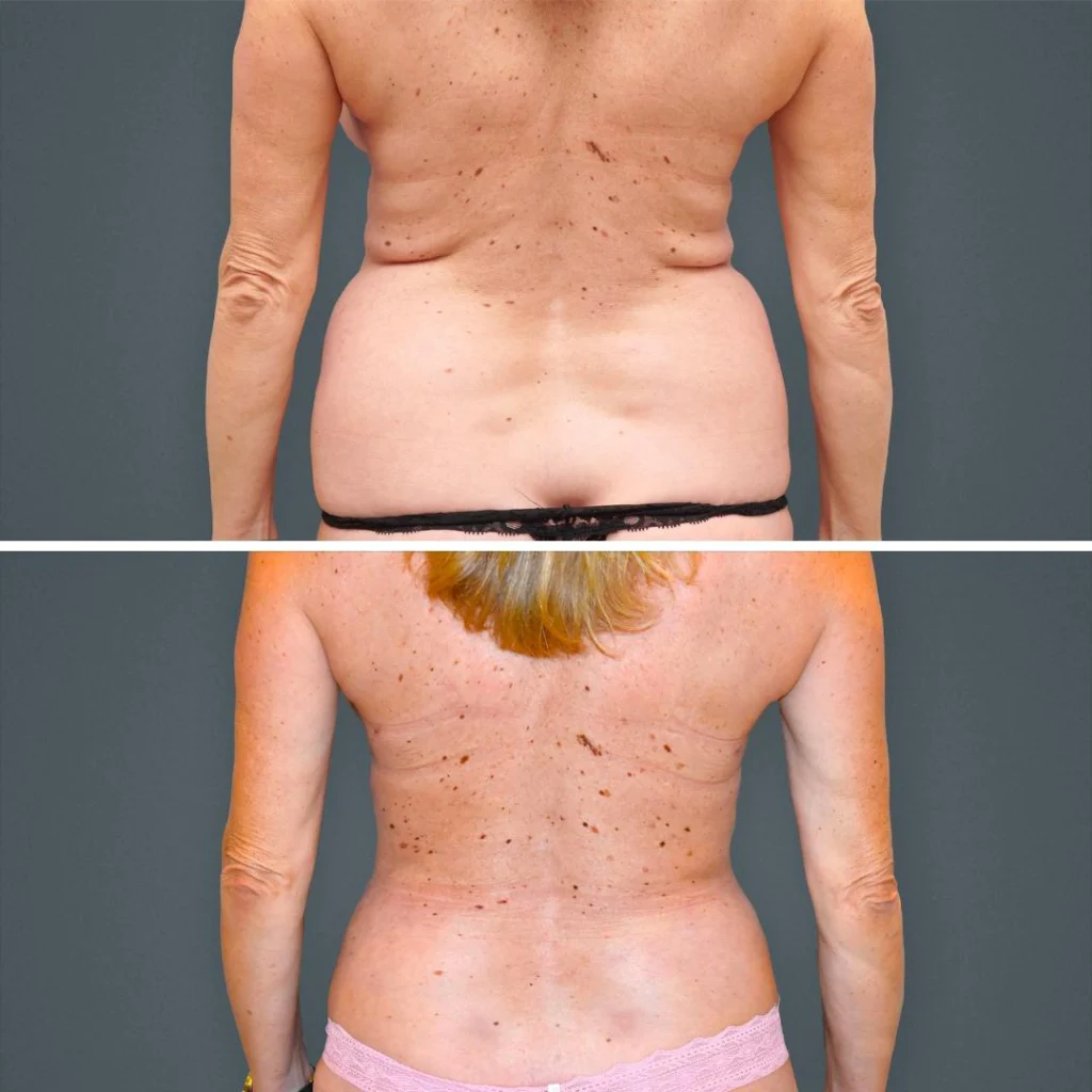 Before and after back liposuction of the flanks.