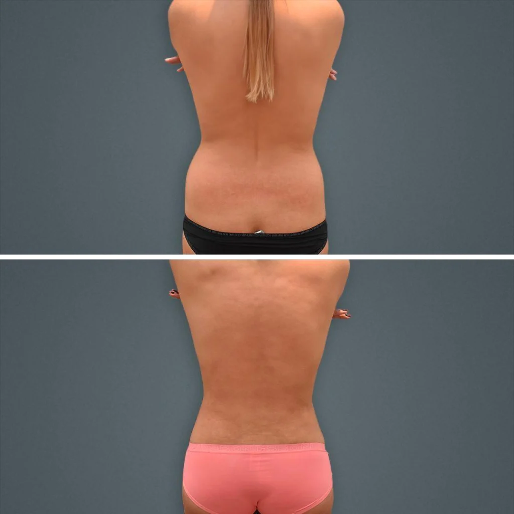 goldcoast liposuction lovehandles female 2023 rear 160 before and after before and after