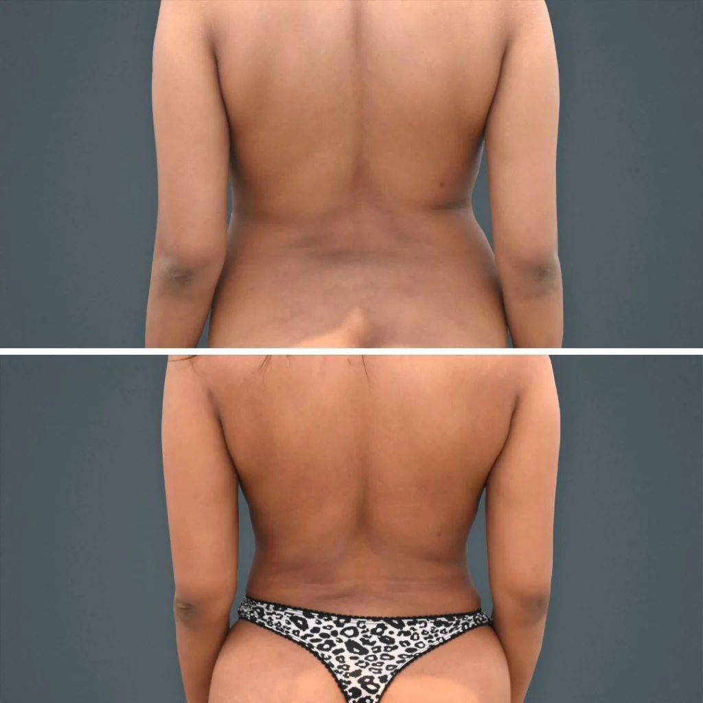 goldcoast liposuction lovehandles female 2023 rear 170 before and after before and after
