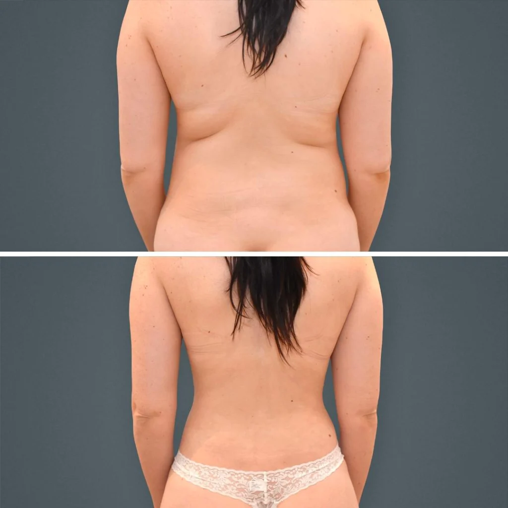 goldcoast liposuction lovehandles female 2023 rear 176 before and after before and after